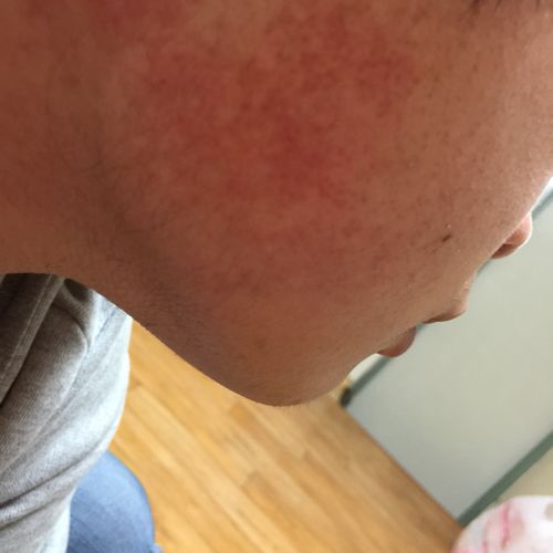 喝红酒后脸上起红点怎么办