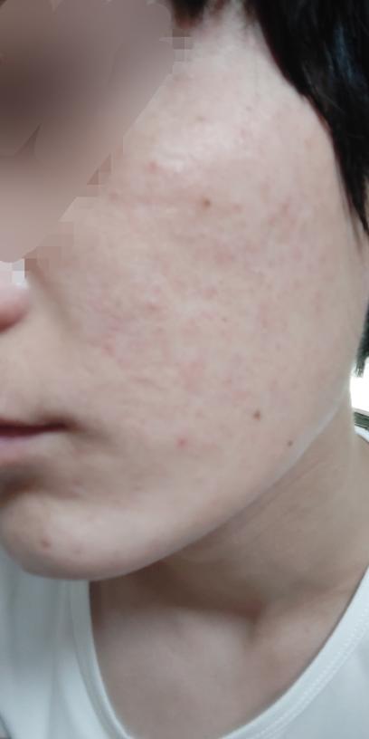 喝了红酒脸上起疙瘩是什么意思